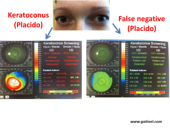 Example of definite forme fruste forms of keratoconus (left eye). The right eye presents advanced keratoconus, while the right eye presents a very early subclinical form, as the values for all indices are below the defined cut-offs (Klyce/Maeda and Smolek/Klyce indices, Keratoconus Screening neural network, Magellan topographer, Nidek, Japan). This eye can be considered to be false-negative for these tests.
