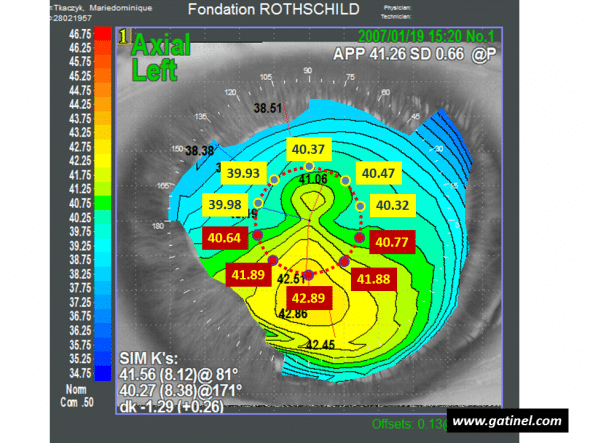Calculation of the I-S index: the diameter of the circle centered on the vertex is 3 mm. The mean of values measured in the superior hemicornea is S = 40.214 D. The mean of values measured in the inferior hemicornea is I = 41.614 D. The (I-S) index is equal to 1.4 D. Despite keratometry values slightly lower than the mean, the (I-S) index indicates the presence of keratoconus-suspect.