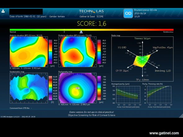SCORE software was applied retrospectively to data of a preoperative Orbscan examination of the right eye with post-LASIK ectasia. It highlights certain preoperative abnormalities (Radar map), as well as a higher thinning rate in the centre (Pachy thinning rate). The score is positive. 