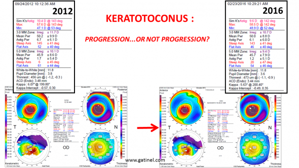 keratoconus progression