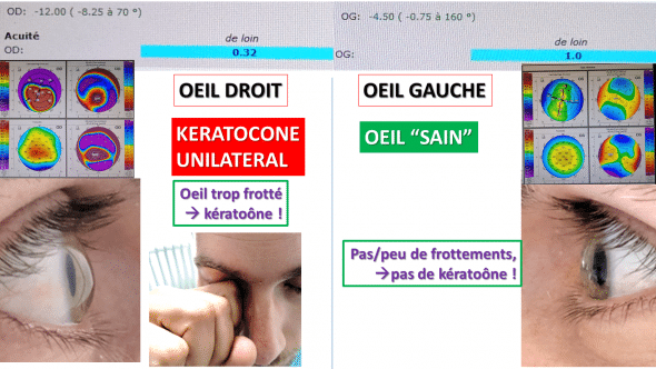keratocone unilateral