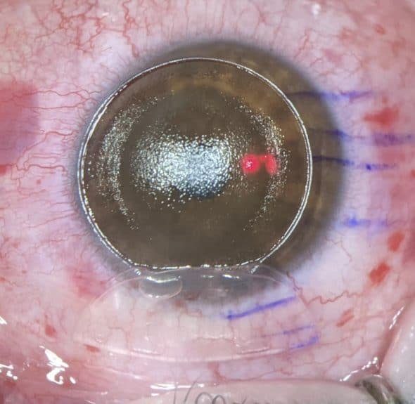 LASIK hypermétropie bombement cornéen