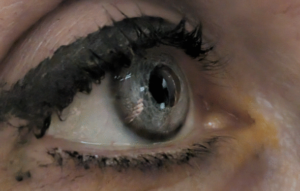 pigment iris kératopigmentation esthétique