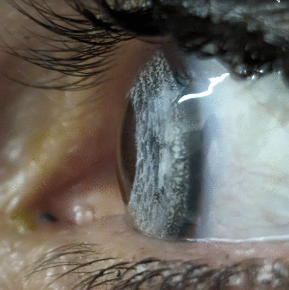 keratopigmentation de profil (oeil bleu gris)